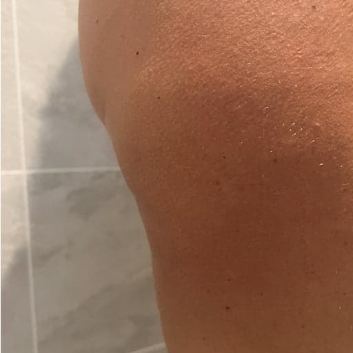 Cellulitt forbedring