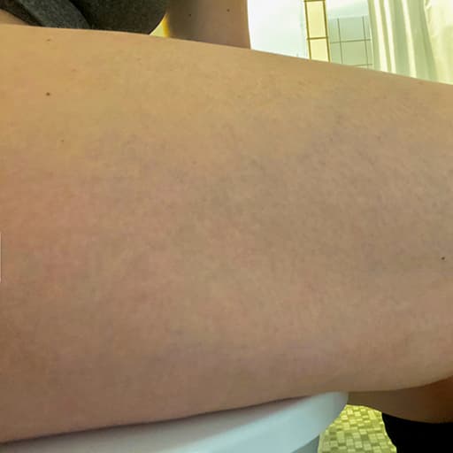 Bilde av Nadja sine lår etter at hun har tatt The Solution 