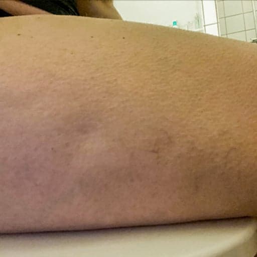 Bilde av Nadjas lår før hun begynte å ta The Solution