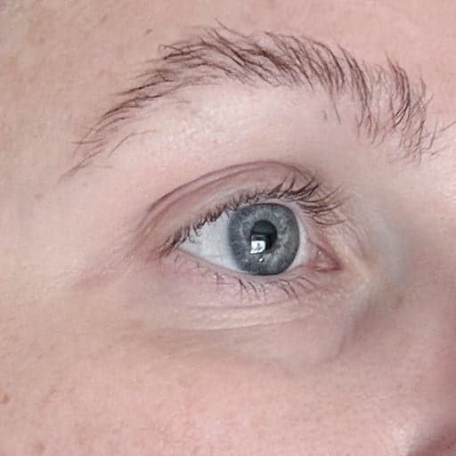 Hud rundt øyne etter The Solution