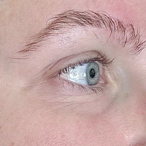 hud rundt øyne før The Solution