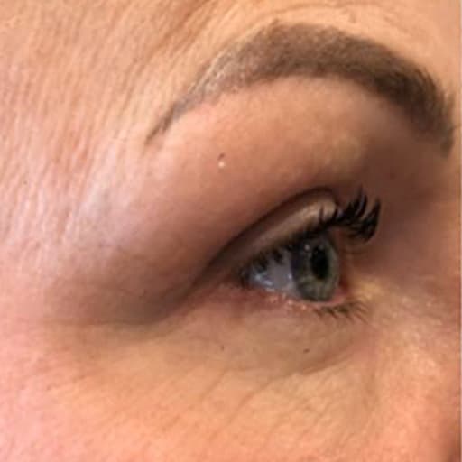 Michelle sin hud før kollagen